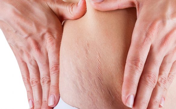 Natural Remedies for Scars and Stretch Marks