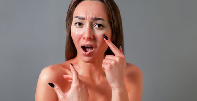 Everything You Need To Know About Treating Sunburn